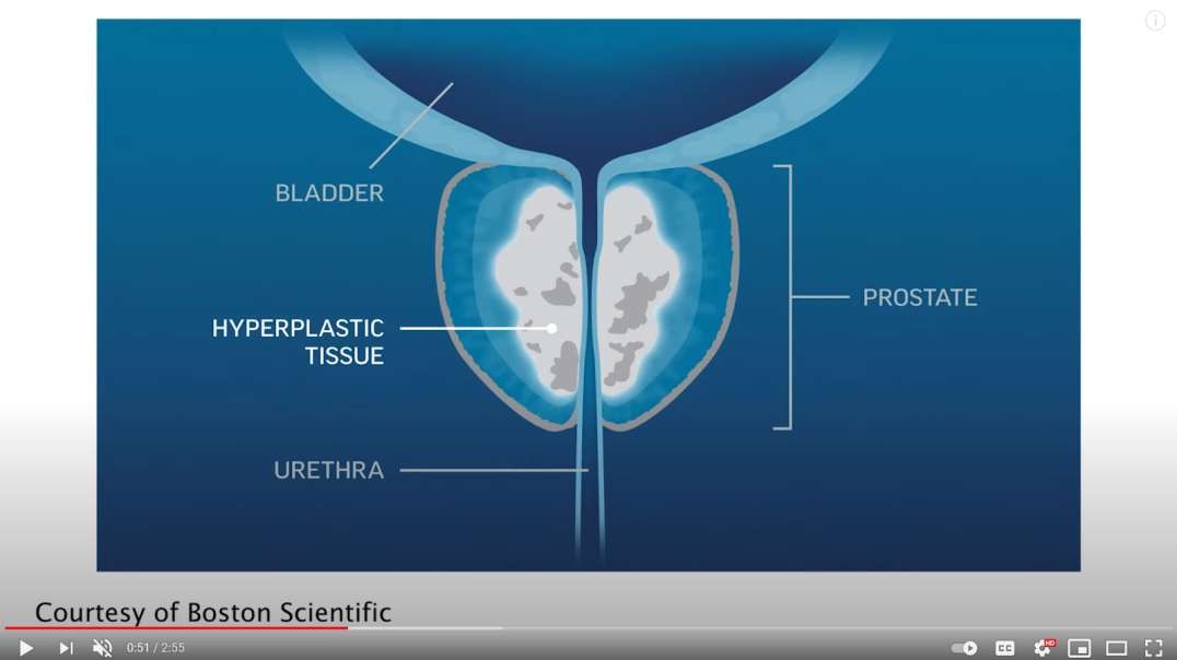 New Bph Treatment For Enlarged Prostate 2540